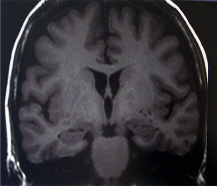 アルツハイマー型認知症とは？