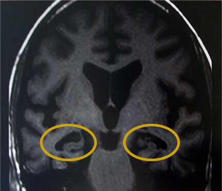 アルツハイマー型認知症とは？