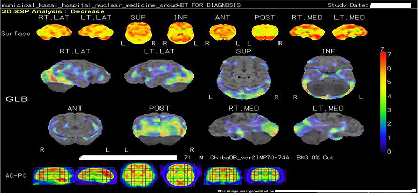 レビー小体型認知症とは？